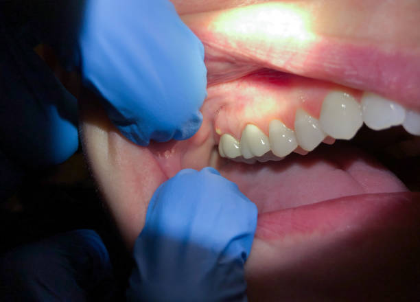Best Emergency Treatment for Dental Infections or Abscesses in Dupont, WA