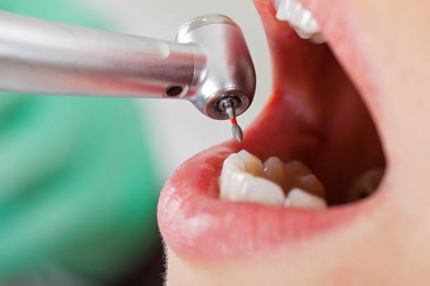 Best Emergency Dental Care for Broken or Chipped Teeth in Dupont, WA